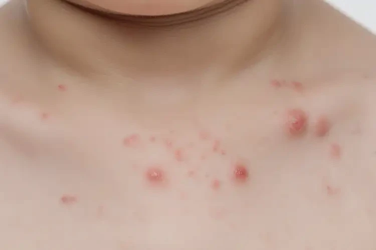 孩子脖子上出現(xiàn)濕疹能夠徹底治愈嗎(圖4)