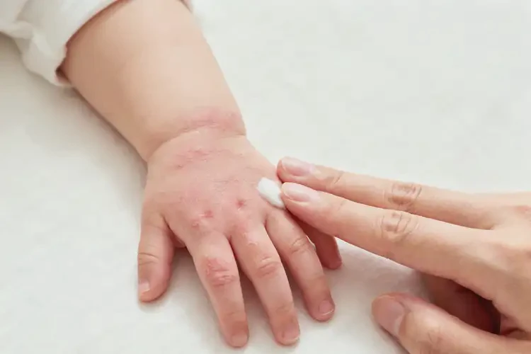 嬰幼兒手上偶爾長濕疹能夠徹底治愈嗎(圖2)
