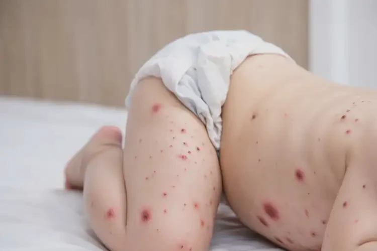 小兒屁股經(jīng)常起濕疹能徹底自愈嗎(圖4)