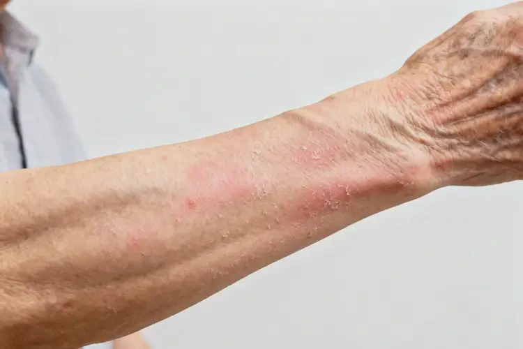 高齡老人手臂上經(jīng)常長濕疹能徹底自愈嗎(圖4)