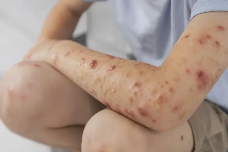 青少年全身出现湿疹能靠自己自愈吗(图4)