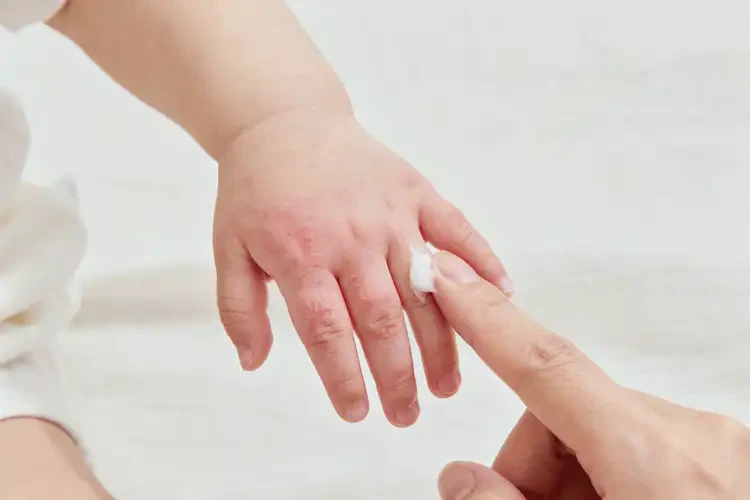 嬰幼兒手上偶爾長濕疹能夠徹底治愈嗎(圖4)