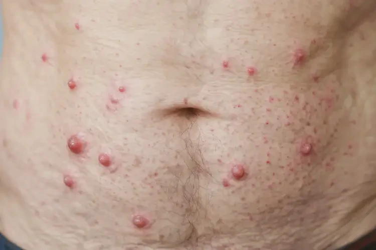 老年人肚子上容易起濕疹能徹底自愈嗎(圖4)