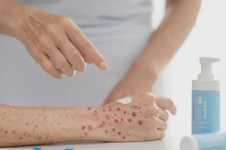女人手臂上出現濕疹可以徹底自愈嗎(圖3)