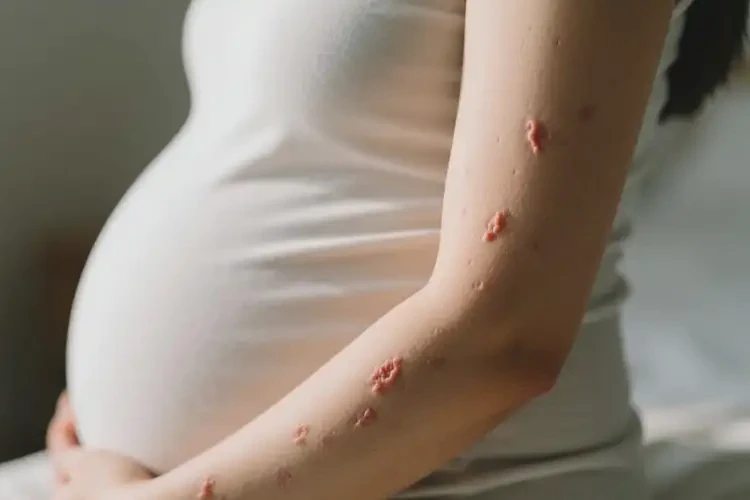 孕婦手臂上出現(xiàn)濕疹能徹底自愈嗎(圖1)