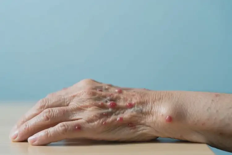 老年人四肢起濕疹不管它會(huì)自己自愈嗎(圖2)