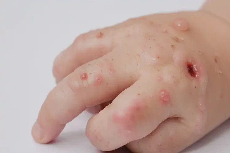 兒童手上經(jīng)常起濕疹能夠徹底治愈嗎(圖4)