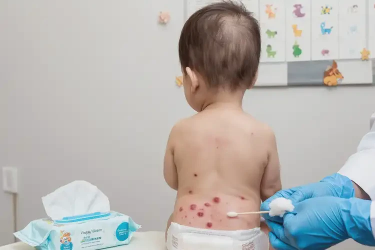 幼兒肛周容易長(zhǎng)濕疹能靠自己自愈嗎(圖4)