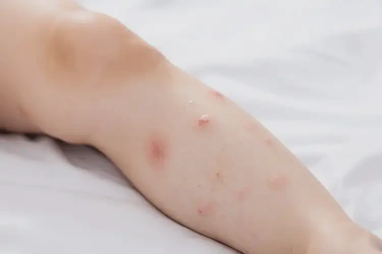 孩子小腿上偶爾長濕疹不管它會自己好嗎(圖2)