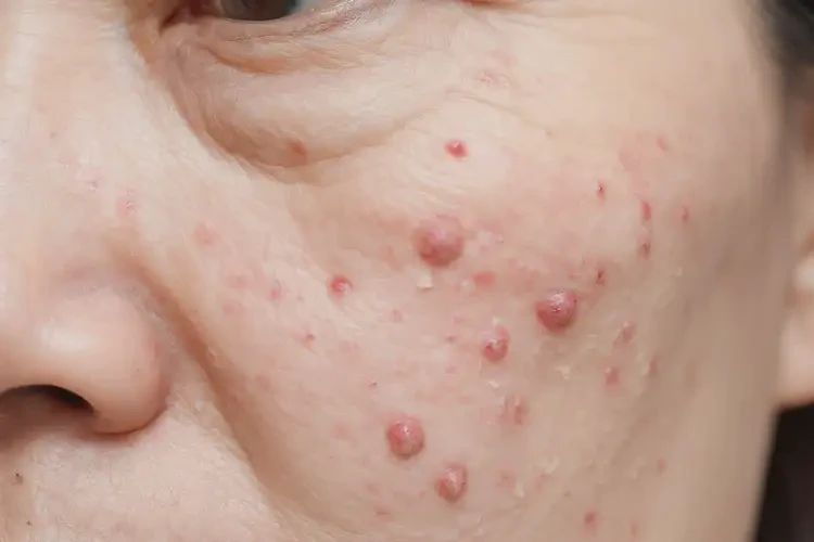 男人肛周出現(xiàn)濕疹不管它會自己自愈嗎(圖4)