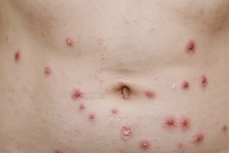 女性肚子上長濕疹不管它會自己好嗎(圖3)