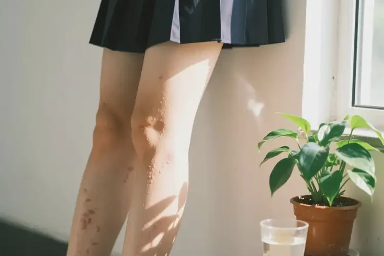 大學(xué)生四肢容易長(zhǎng)濕疹可不可以徹底自愈(圖3)