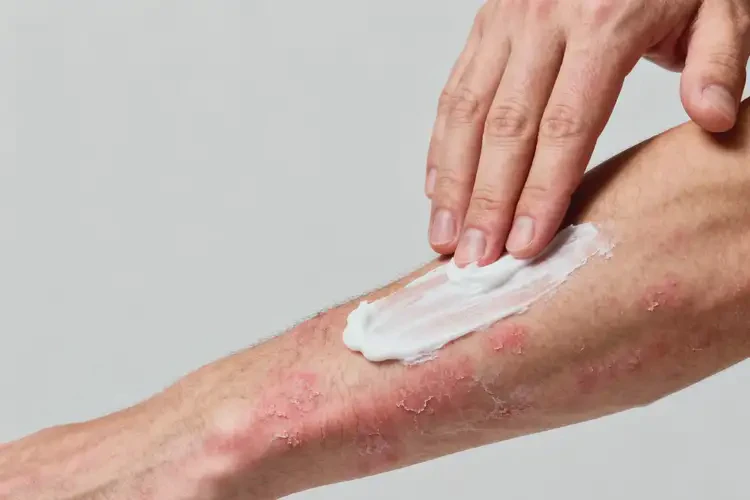 男性手臂上經(jīng)常起濕疹能徹底自愈嗎(圖3)