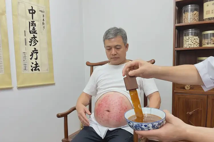 男性肚子上經(jīng)常長濕疹能夠徹底治愈嗎(圖1)