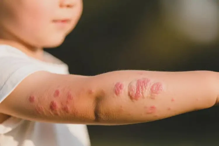 孩子手臂上容易起濕疹不管它會自己自愈嗎(圖2)