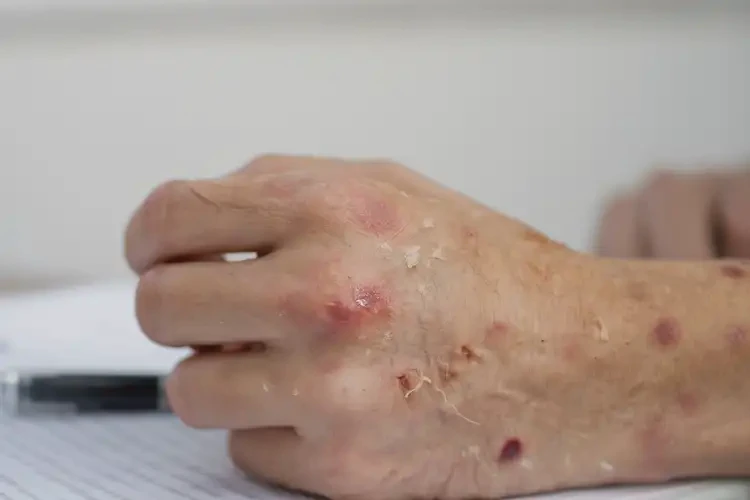 中學(xué)生手上長濕疹可以徹底自愈嗎(圖4)