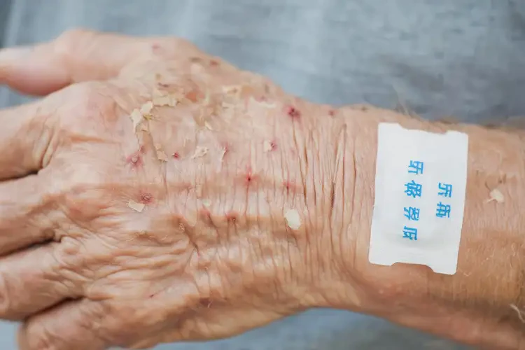 老年人身上長濕疹能徹底自愈嗎(圖4)