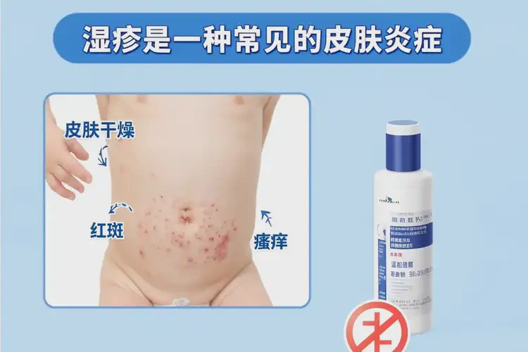 幼兒肚子上出現(xiàn)濕疹能不能徹底自愈(圖4)