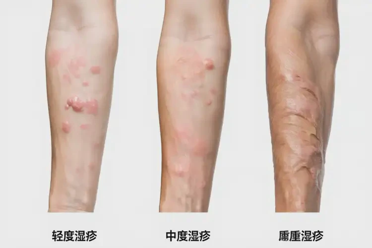 女性肚子經(jīng)常長濕疹可不可以徹底自愈(圖1)