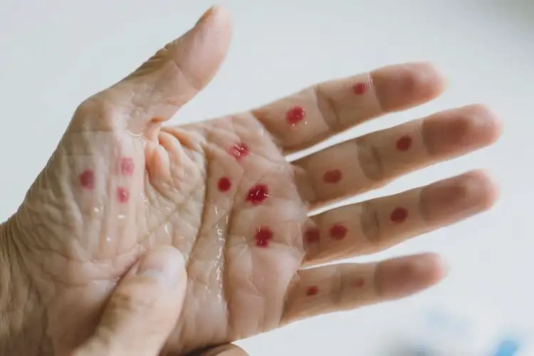 老人手上出現(xiàn)濕疹可以徹底自愈嗎(圖1)