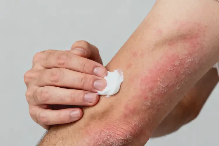 男性手臂上經(jīng)常起濕疹能徹底自愈嗎(圖1)