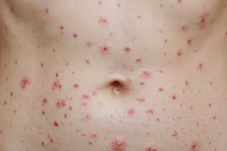 女人肚子偶爾起濕疹能徹底自愈嗎(圖4)