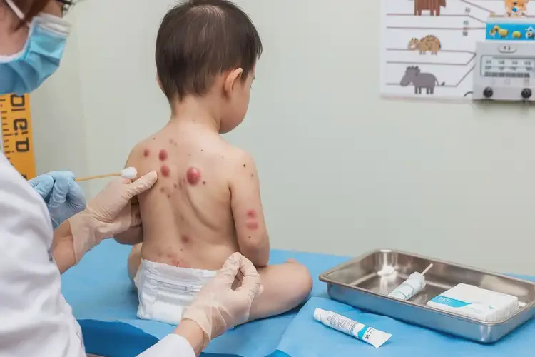 幼兒肛周容易長(zhǎng)濕疹能靠自己自愈嗎(圖3)