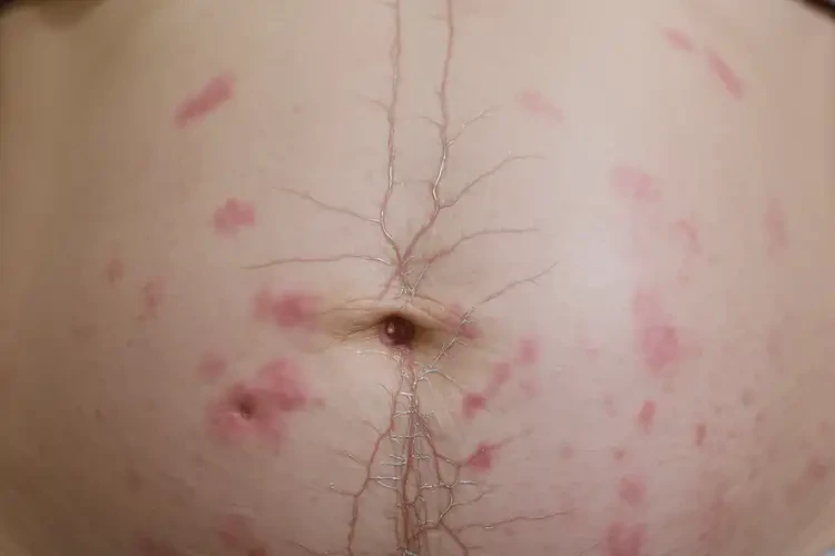 產(chǎn)婦肚子起濕疹能靠自己自愈嗎(圖4)