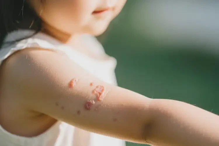 小學生四肢容易起濕疹能徹底自愈嗎(圖4)