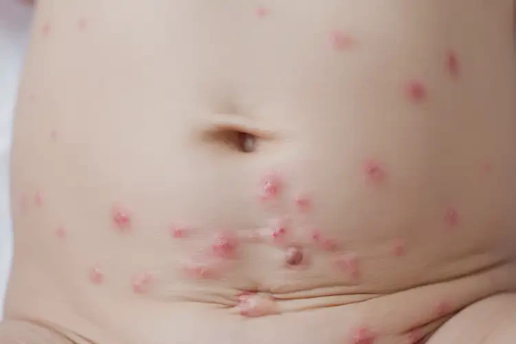 新生兒肚子上長濕疹不管它會自己自愈嗎(圖4)