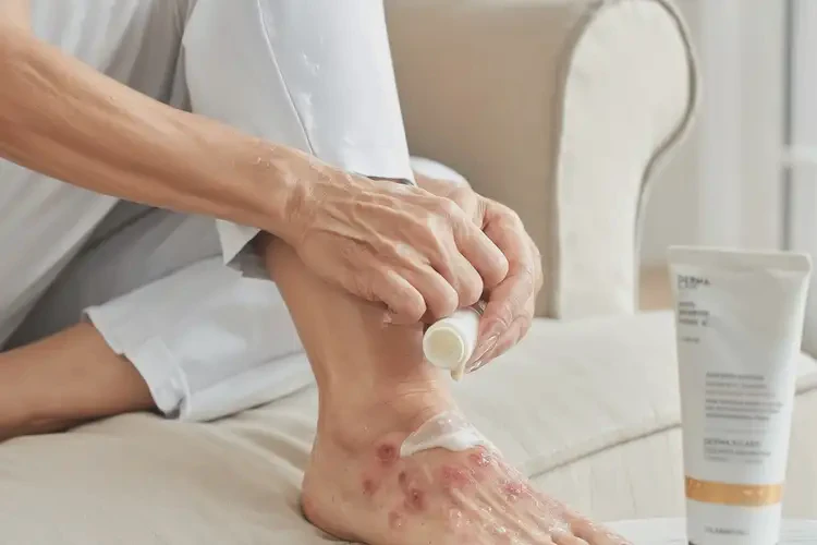 女生腳上容易長濕疹不管它會自己自愈嗎(圖2)