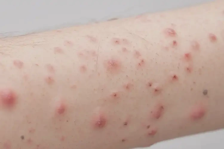 中學(xué)生手臂上經(jīng)常長(zhǎng)濕疹能徹底自愈嗎(圖4)