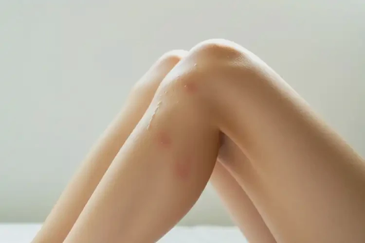 女生大腿上容易長濕疹可以徹底自愈嗎(圖4)