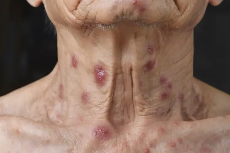 老年人脖子上出濕疹可不可以徹底自愈(圖4)