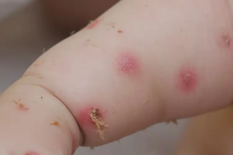 嬰幼兒手臂長濕疹能徹底自愈嗎(圖4)