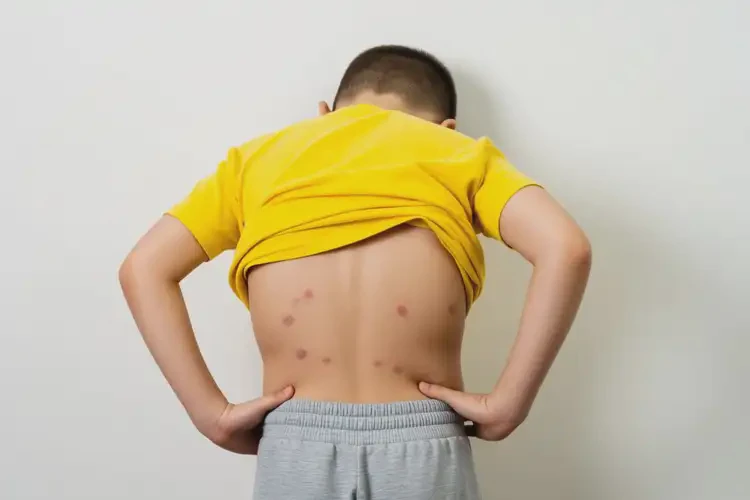 小學(xué)生全身偶爾起濕疹不管它會(huì)自己好嗎(圖2)