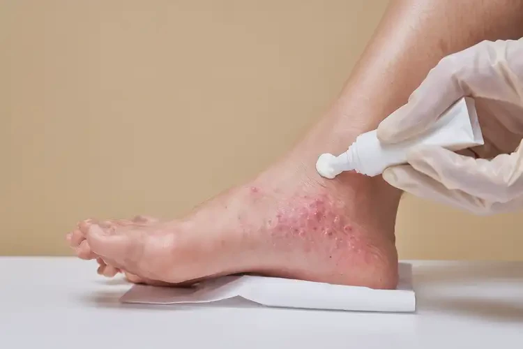 女生腳上容易長濕疹不管它會自己自愈嗎(圖3)