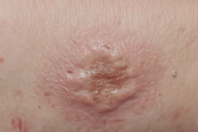 男人手臂出現(xiàn)濕疹不管它會自己自愈嗎(圖2)