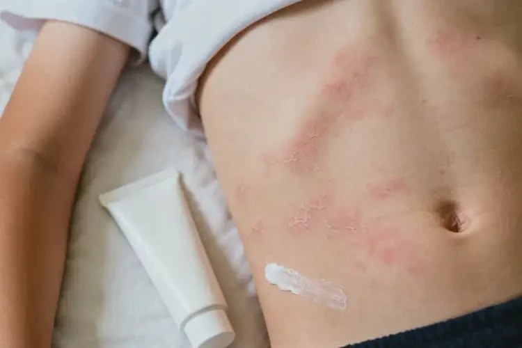 中學生肚子有濕疹能夠徹底治愈嗎(圖4)