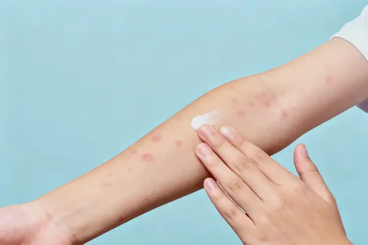 青少年手臂上長(zhǎng)濕疹能夠徹底治愈嗎(圖2)