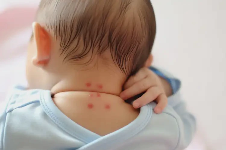 孩子脖子容易長(zhǎng)濕疹不管它會(huì)自己痊愈嗎(圖4)