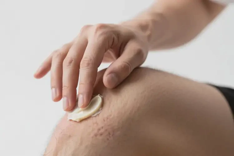 男性大腿上经常起湿疹可不可以彻底自愈(图2)