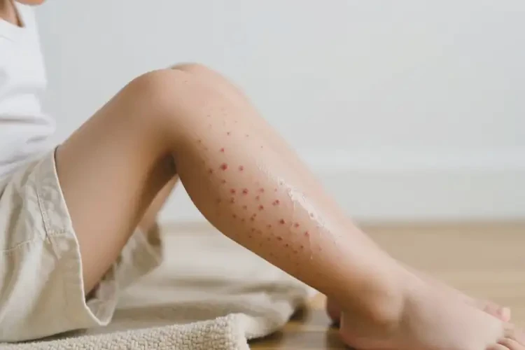 少兒大腿上經常起濕疹不管它會自己自愈嗎(圖3)