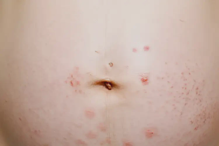 孕婦身上有濕疹能徹底自愈嗎(圖4)