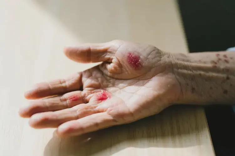 老人手上有濕疹不管它會(huì)自己痊愈嗎(圖3)