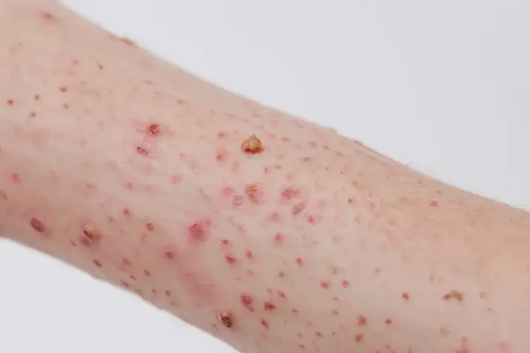 小孩手臂上長(zhǎng)濕疹能夠徹底治愈嗎(圖4)