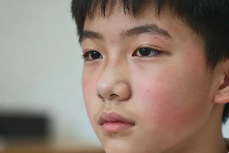 中學(xué)生面部經(jīng)常長濕疹不管它會自己自愈嗎(圖2)