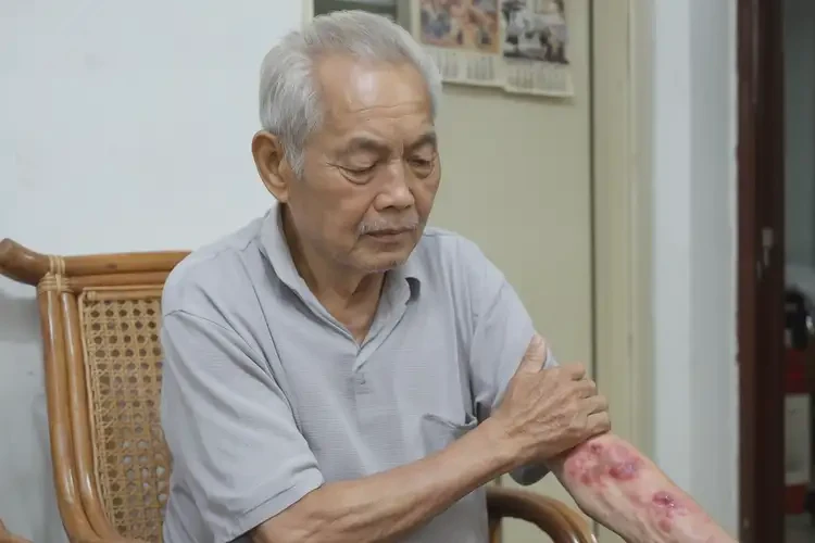 高齡老人手臂經(jīng)常長濕疹不管它會自己痊愈嗎(圖3)