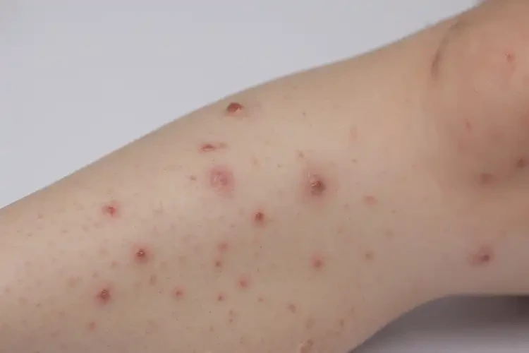 小學(xué)生大腿上起濕疹能夠徹底治愈嗎(圖4)