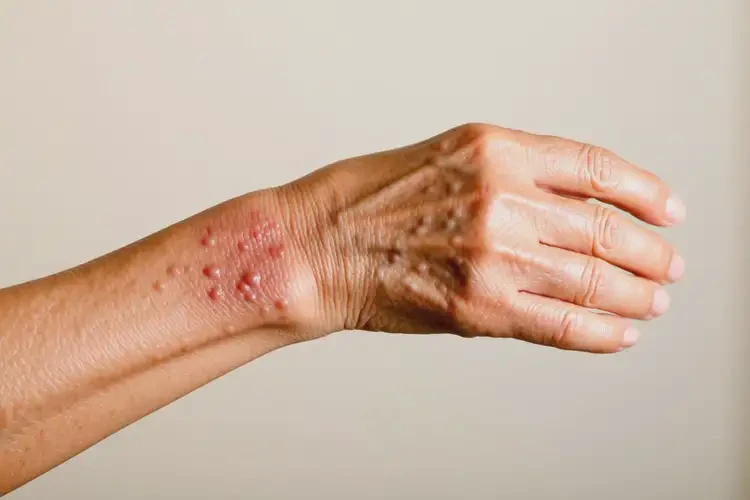 老人手臂起濕疹不管它會自己痊愈嗎(圖2)